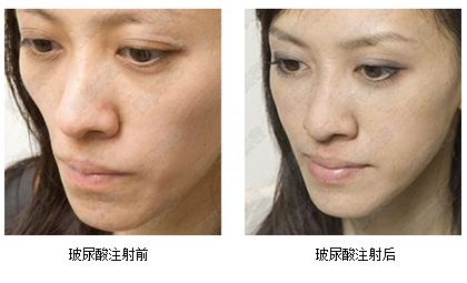 玻尿酸效果图