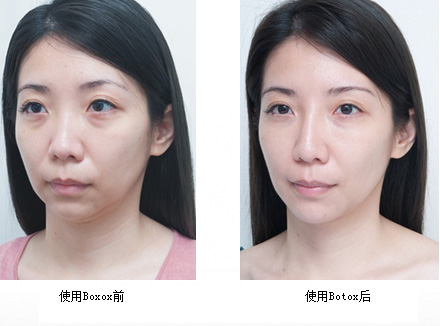 瘦脸针对比效果图