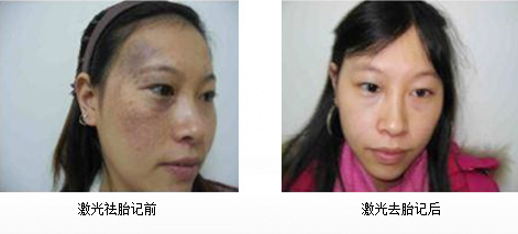 去胎记效果图